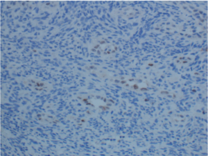 Figure 8: Lateral neck lymph node mass: Pax 8 stain is positive in rare scattered cells- Unified Citation Journals
