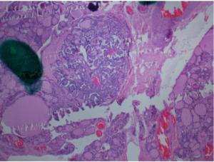 Figure 9: Thyroid lobe : Dot is papillary microcarcinoma-- Unified Citation Journals